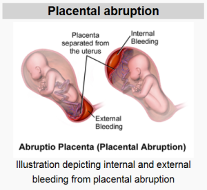 placental abruption image