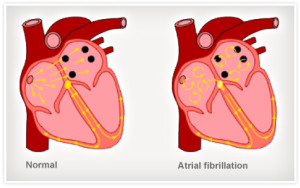 atrial fib image